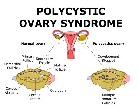 Polycystic Ovary Syndrome (PCOS) .